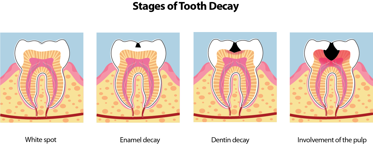 Image showing stages of tooth decay